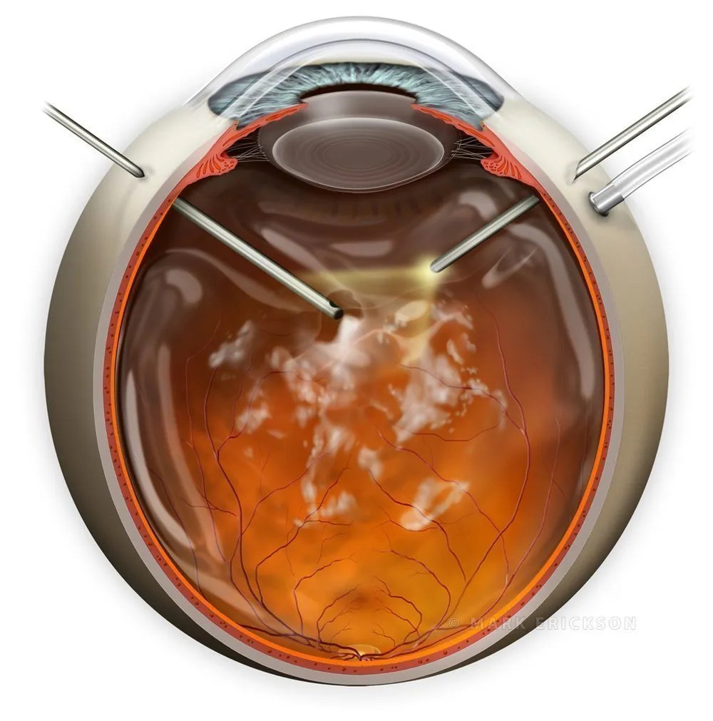 Pars plana vitrectomy PPV for vitreous debris, surgery illustration