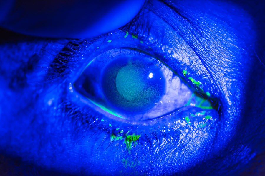 Corneal Erosion Eye Patient