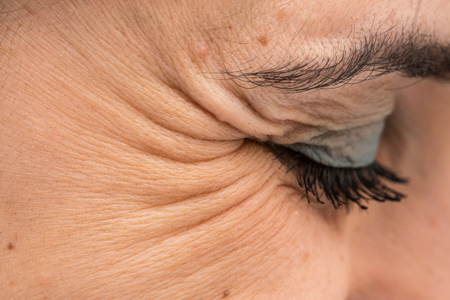 Crow's Feet Eye Patient