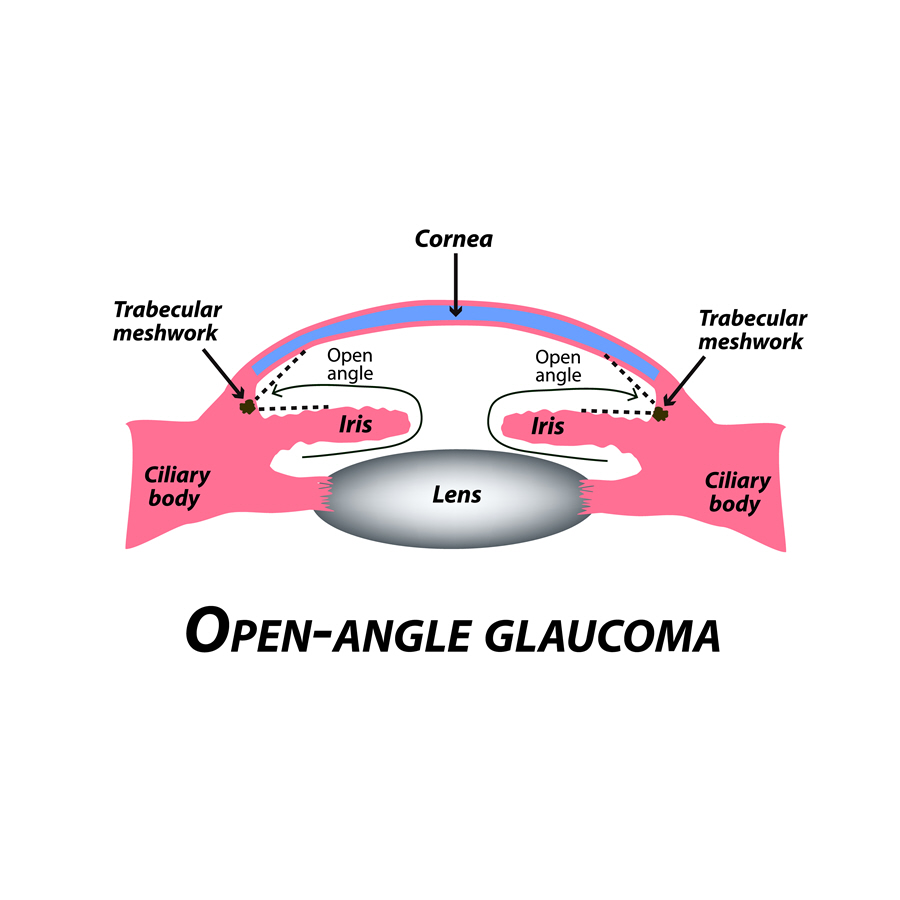 Openangle Eye Patient