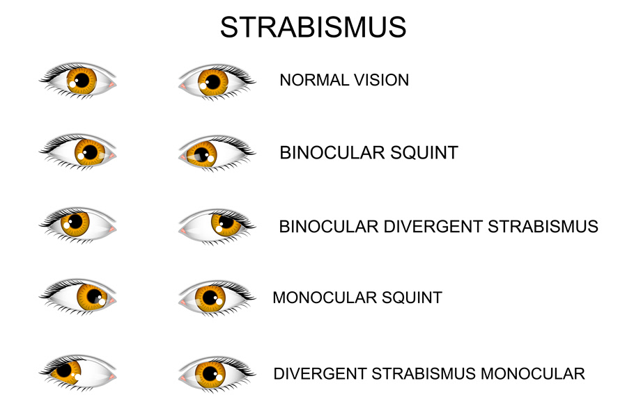 Strabismus Eye Patient