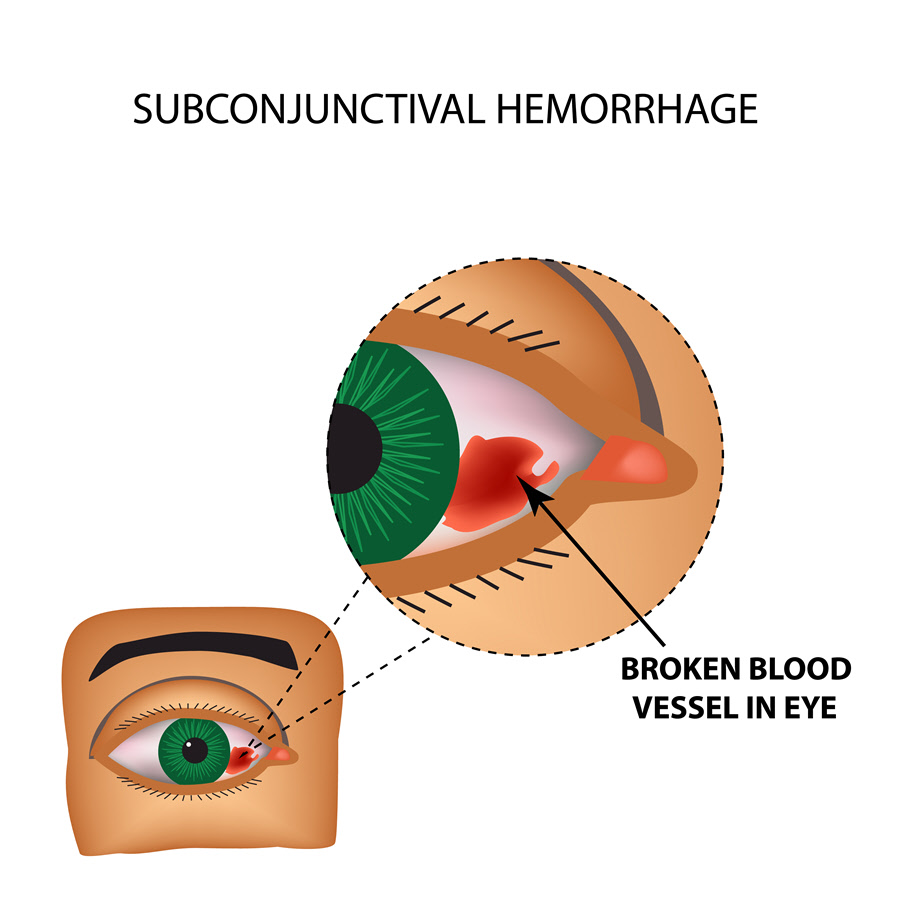 Subconjunctival Hemorrhage Eye Patient