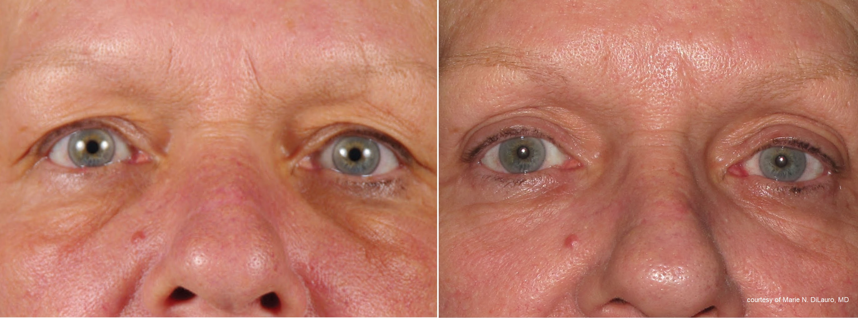 Broadband Light Therapy BBL Treatment Near Me