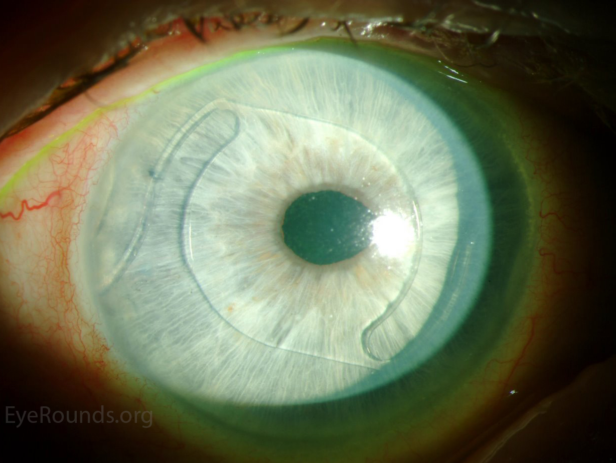 Atlas Entry Anterior chamber intraocular lens (ACIOL) implant