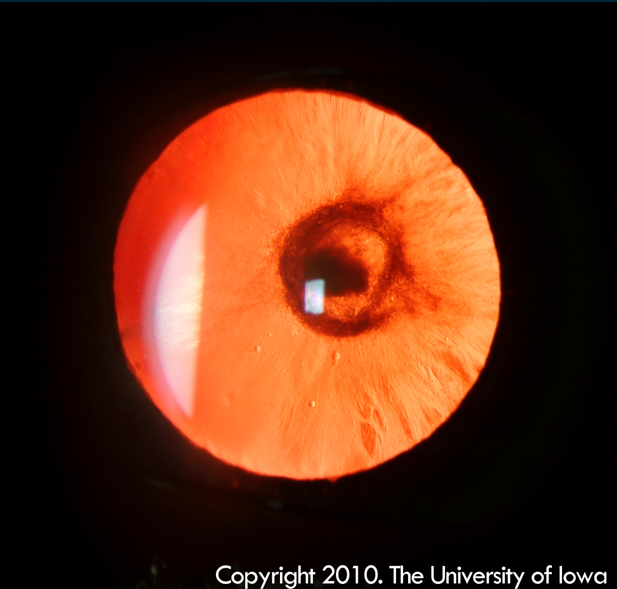 Posterior Polar Cataract. Ophthalmology The University of Iowa