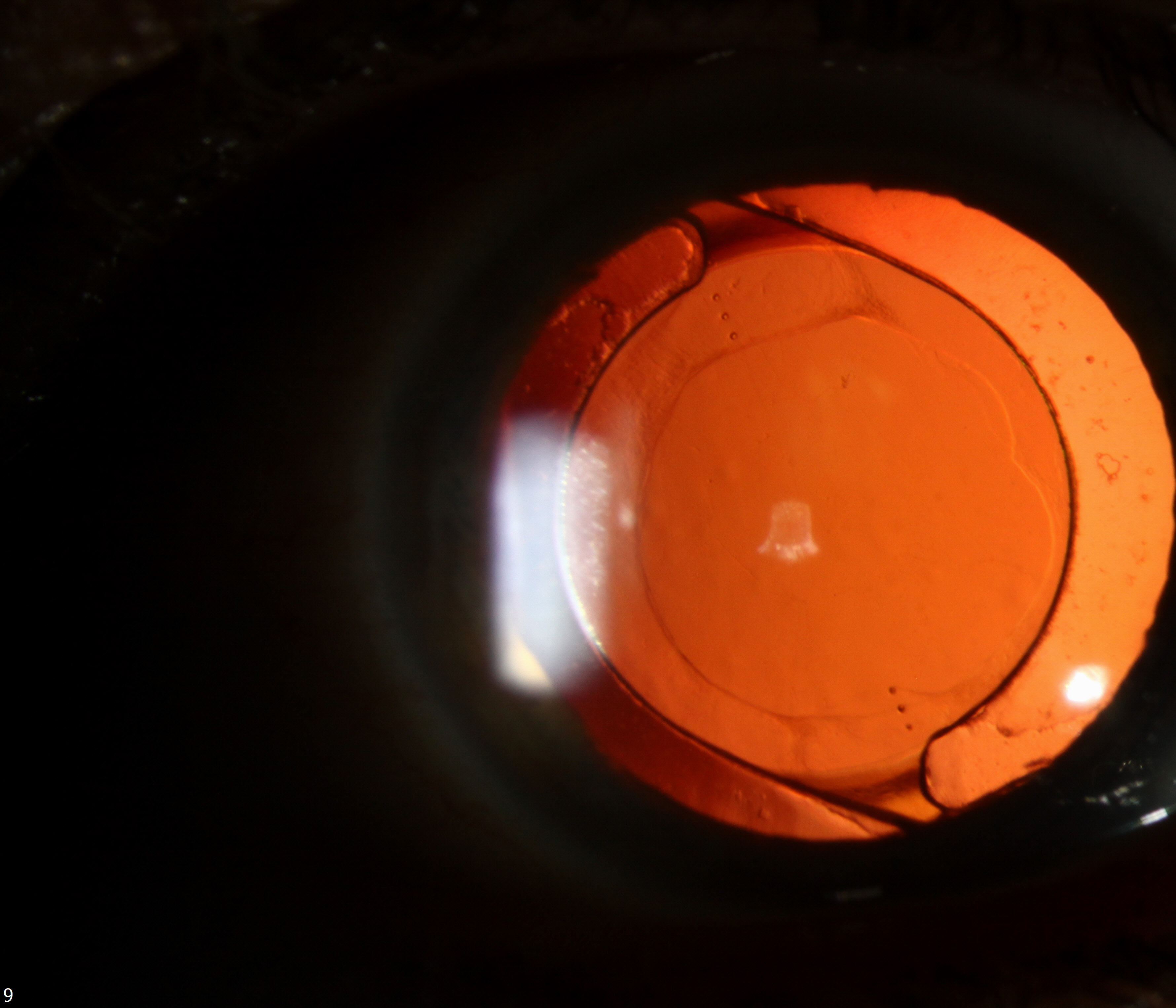 Toric Lens IOL exchange The University of Iowa, Ophthalmology