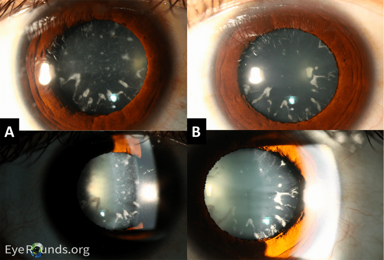 Electrocution Induced Cataracts and Macular Hole