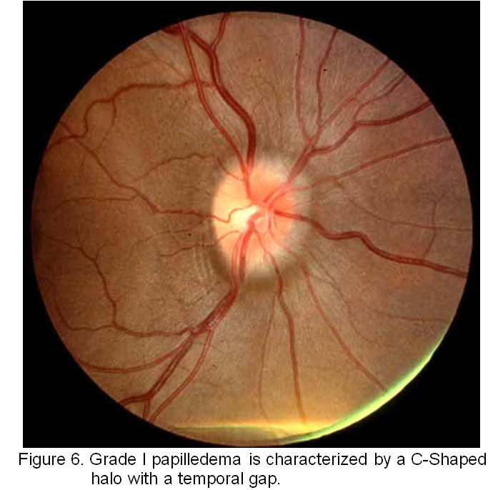 Papilledema Grades. Ophthalmology The University of Iowa