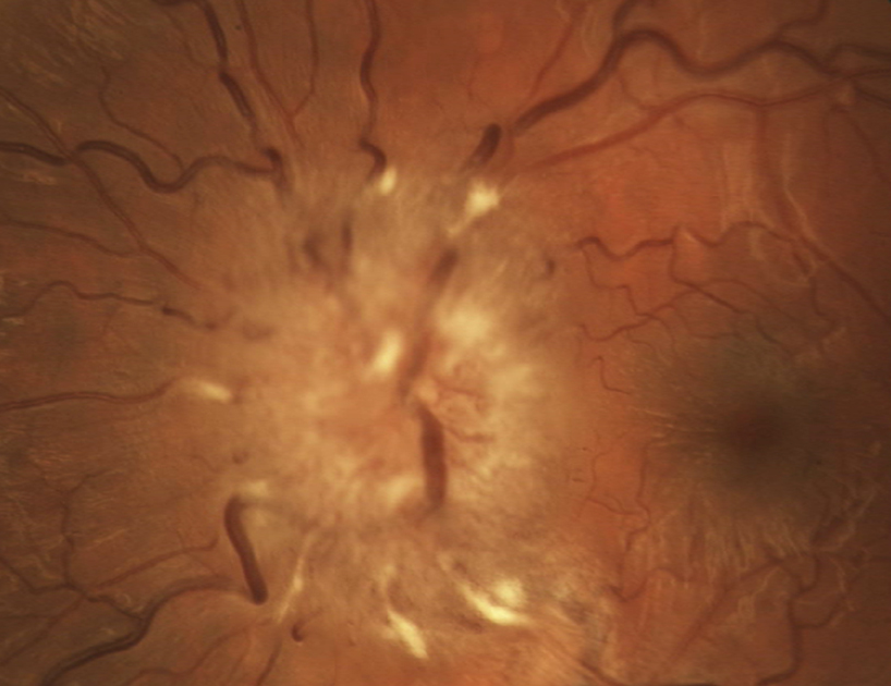 Papilledema Grades. Ophthalmology The University of Iowa