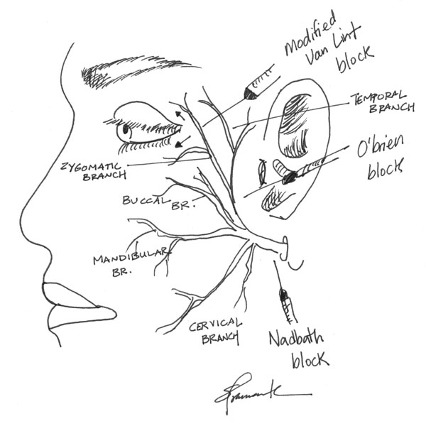 Retrobulbar Block, Peribulbar block and Common Nerve
