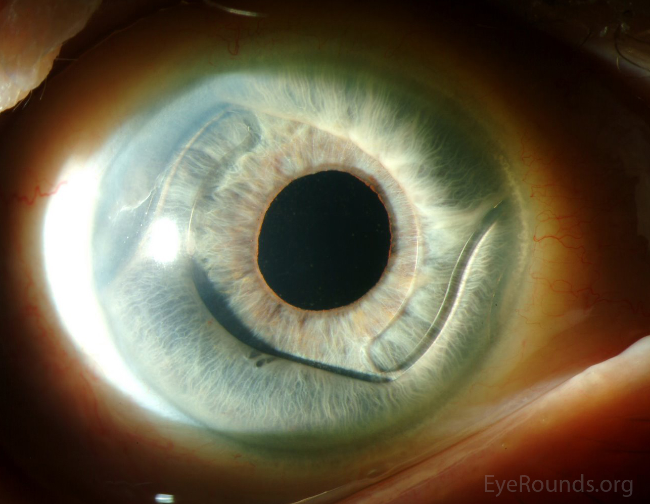EyeRounds. Case reports, tutorials, videos, images from Univ of Iowa Dept of Ophthalmology