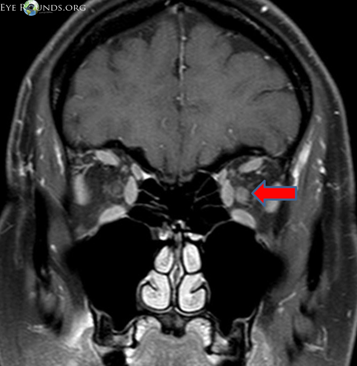 Optic neuritis from one medical student to another medical student
