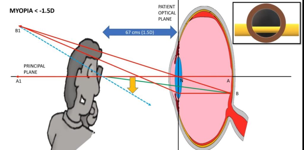 Why we get with and against reflex movements in retinoscopy