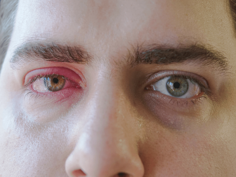 Contraindications for contact lens 20 conditions to avoid EyesMatterMost