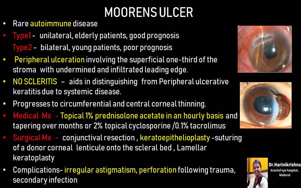 Moorens Ulcer EyeToday