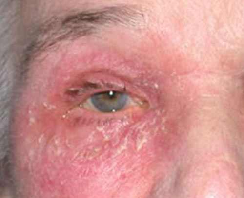 Causes and Treatment for Red Itchy Eyelids