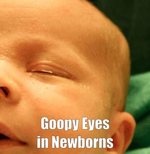 Goopy Eyes in Newborns