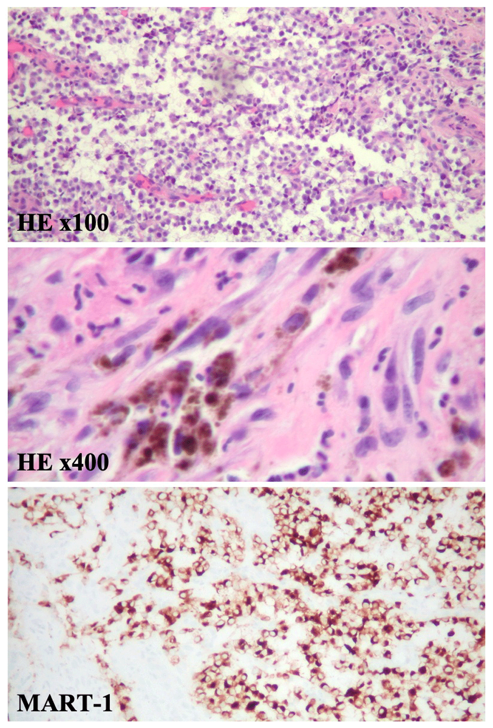 Case Report Primary melanoma of the... F1000Research