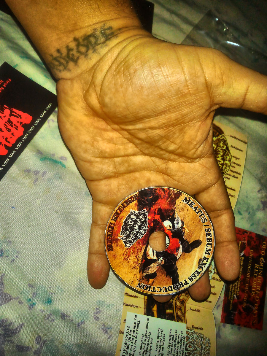 Minimal Excision Technique for Removal of an Epidermoid CystIn Cyst We