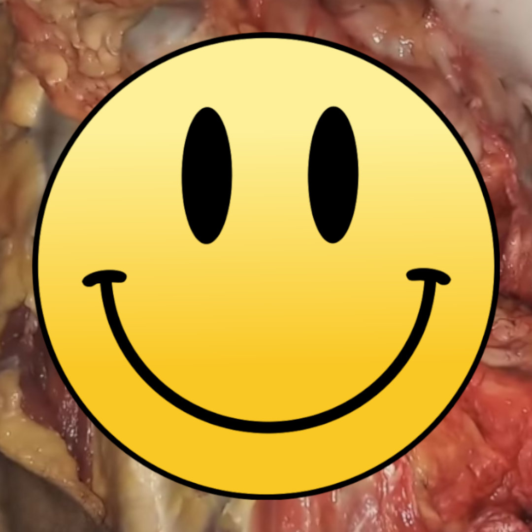 Congenital Disorder Caused By The Closing Of The Neural Tube