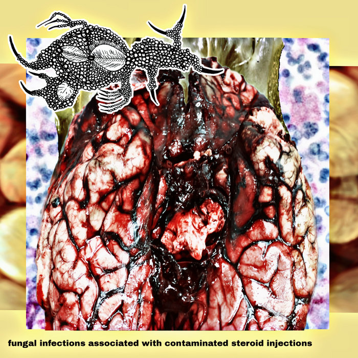 Fungal Infections Associated With Contaminated Steroid Injections