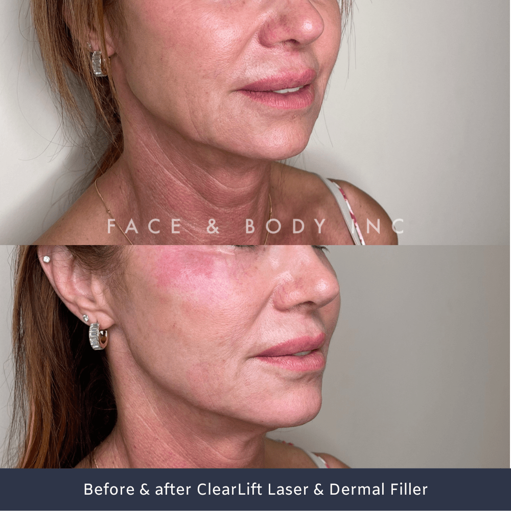 ClearLift Laser Face and Body Inc