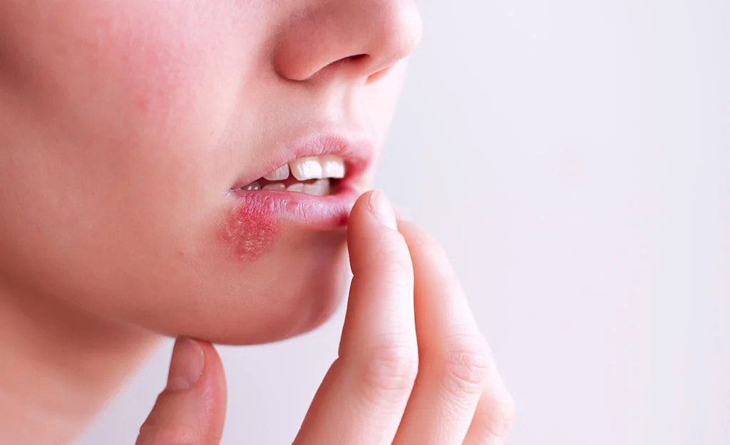 Tips for Managing a Cold Sores Natural Remedies