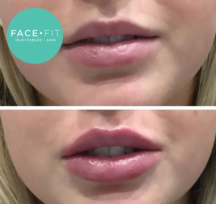 Lip Injections Before and After Face Fit