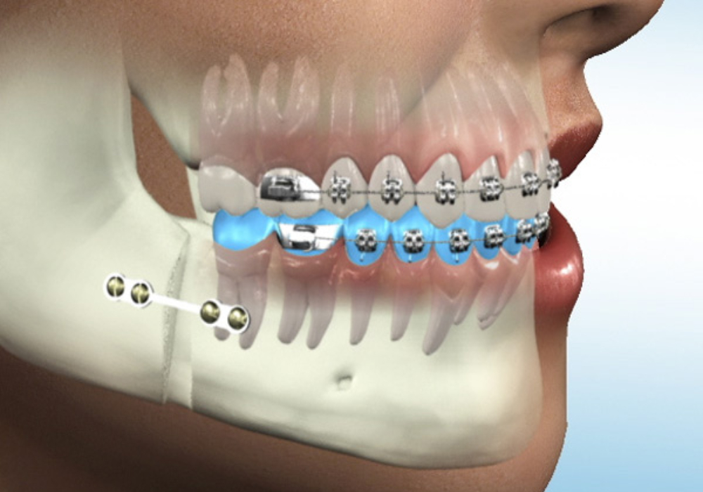 1 Best Oral & MaxilloFacial Surgery in Nigdi Pune Face N Dental