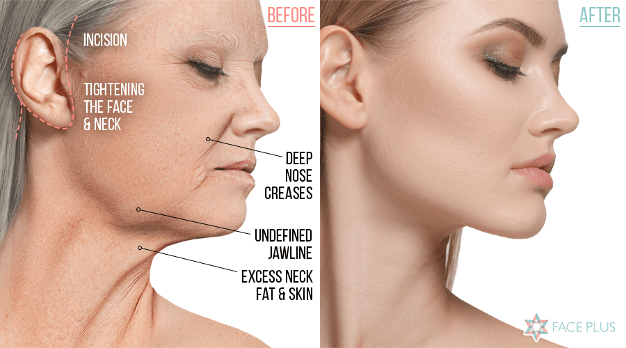 Face and Neck Lift Face Plus Clinic Korea