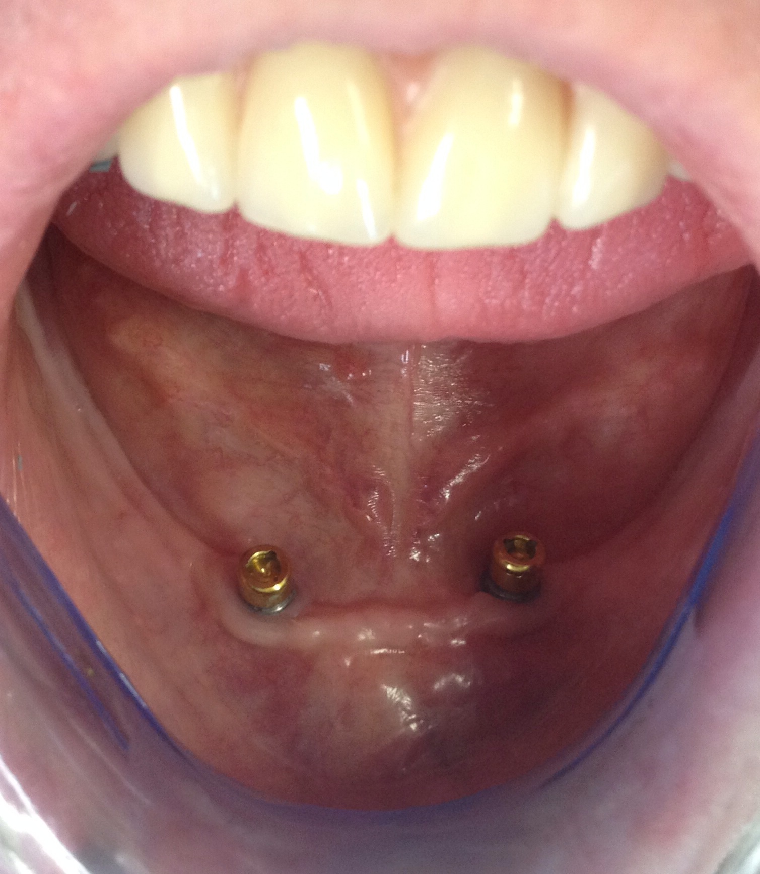 Photo GalleryImplant Retained Denture Facial Surgery UK