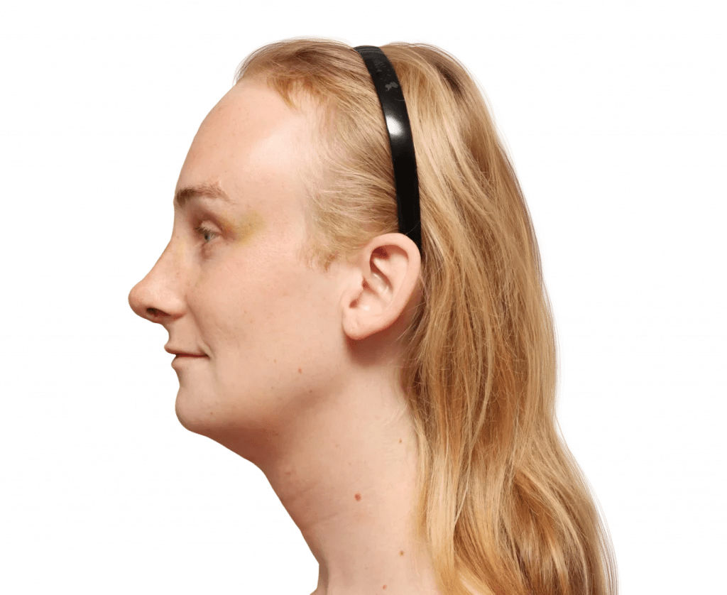 Yvette Before and After FFS Surgery — Facialteam