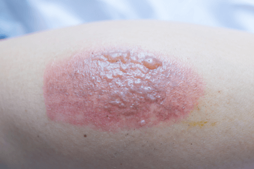 Ringworm Overview, facts, symptoms, causes, treatment, & prevention