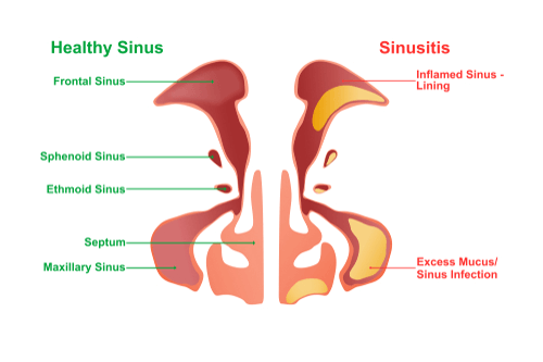 Exercise Induced Rhinitis Definition ExerciseWalls