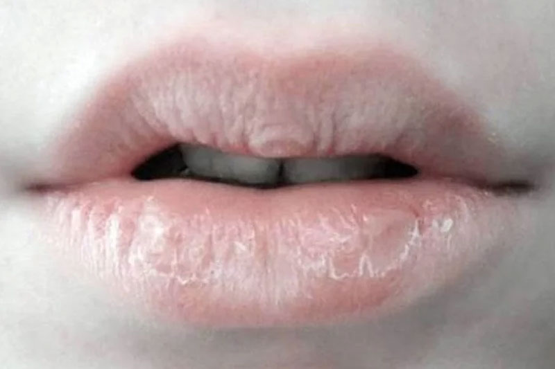Don't Ignore These 10 Health Warning Signs Your Lips are Telling You