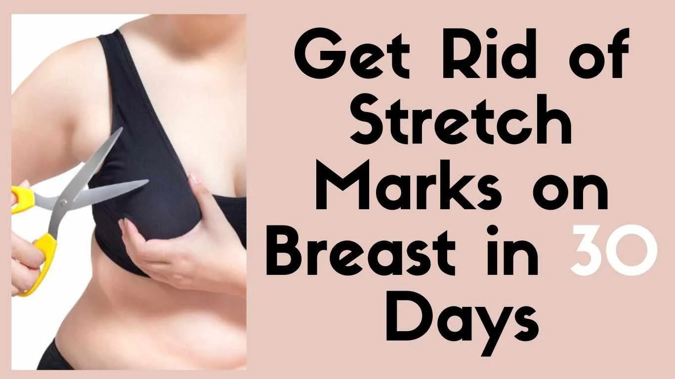 Get Rid of Stretch Marks on Breast in 30 Days facts