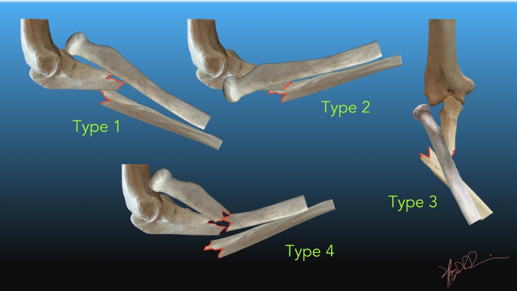 Bado Classification of Monteggia fractures UW Emergency Radiology