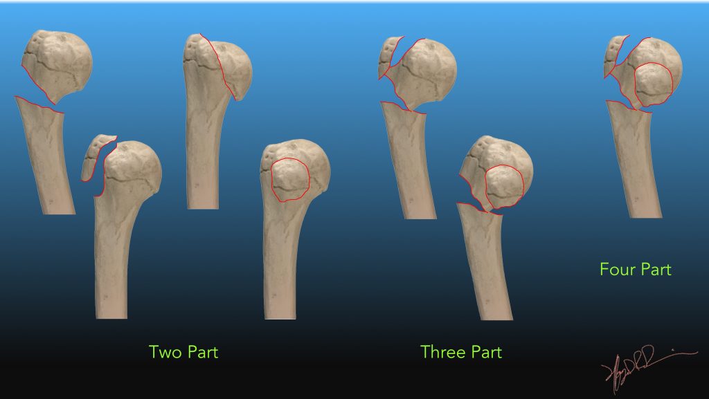 Neer Classification of Humeral Head Fractures UW Emergency Radiology