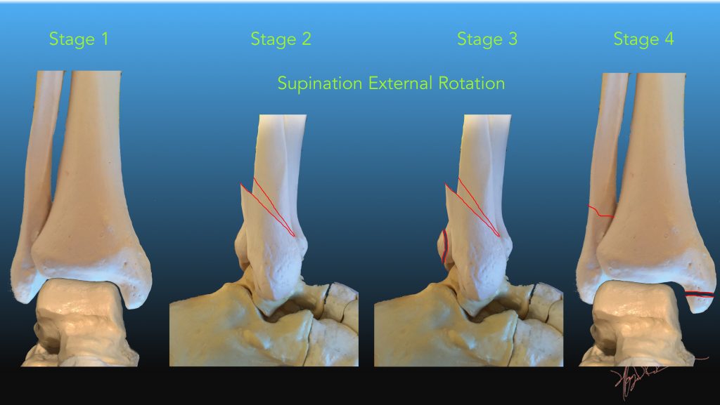 Lauge Hansen Classification of Ankle Fractures UW Emergency Radiology
