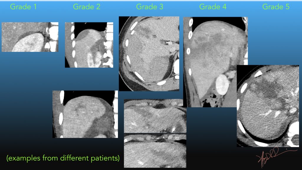 AAST Liver Injury Scale 2018 revision UW Emergency Radiology
