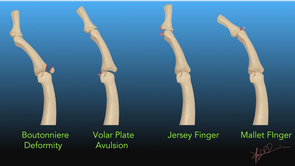 Finger Fractures UW Emergency Radiology