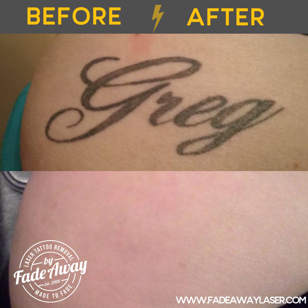 Portfolio Fade Away Laser