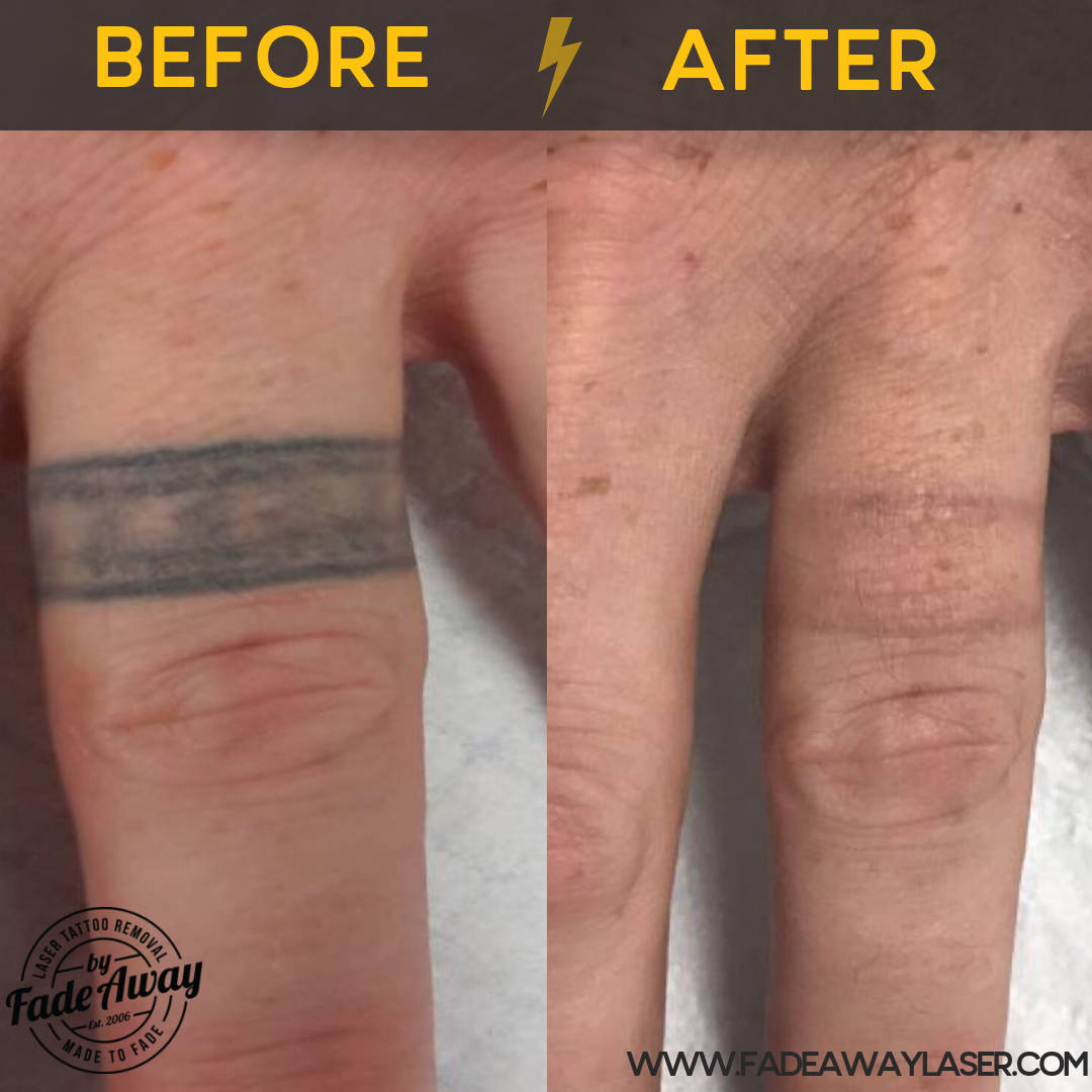 Portfolio Fade Away Laser