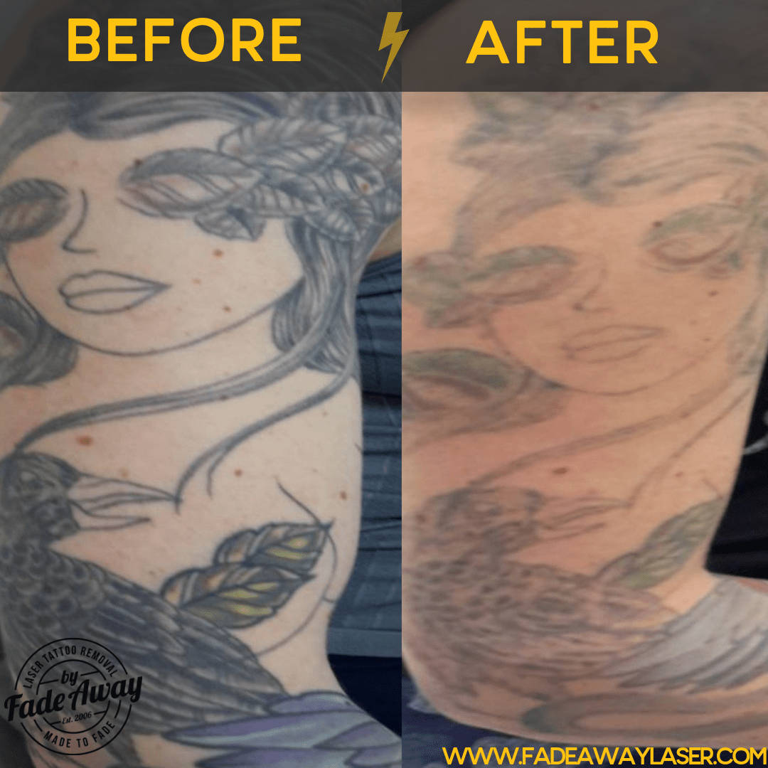 Portfolio Fade Away Laser