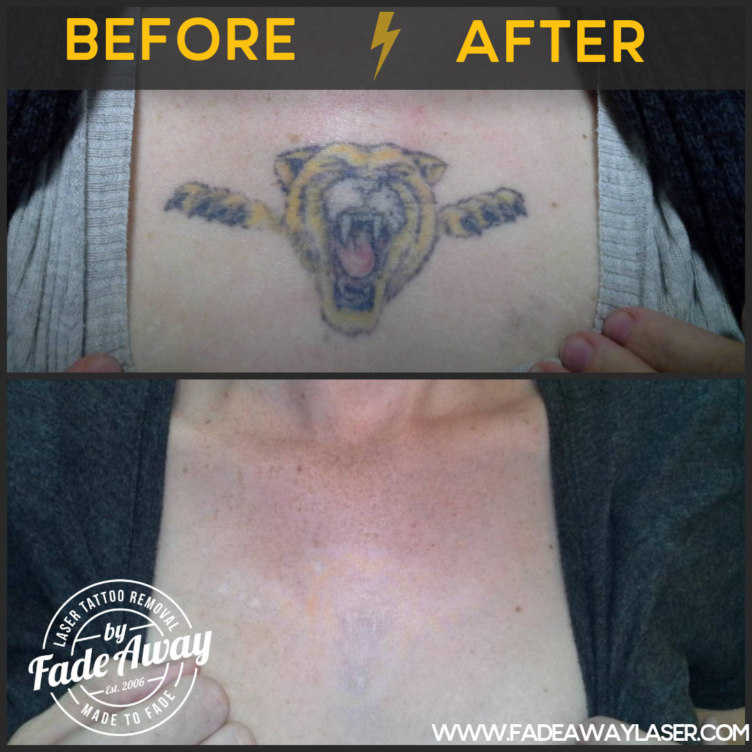 Portfolio Fade Away Laser