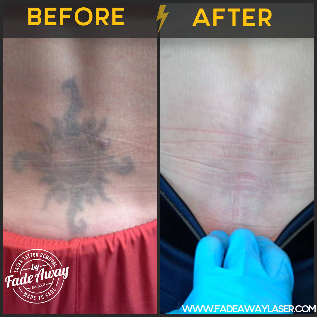 Portfolio Fade Away Laser