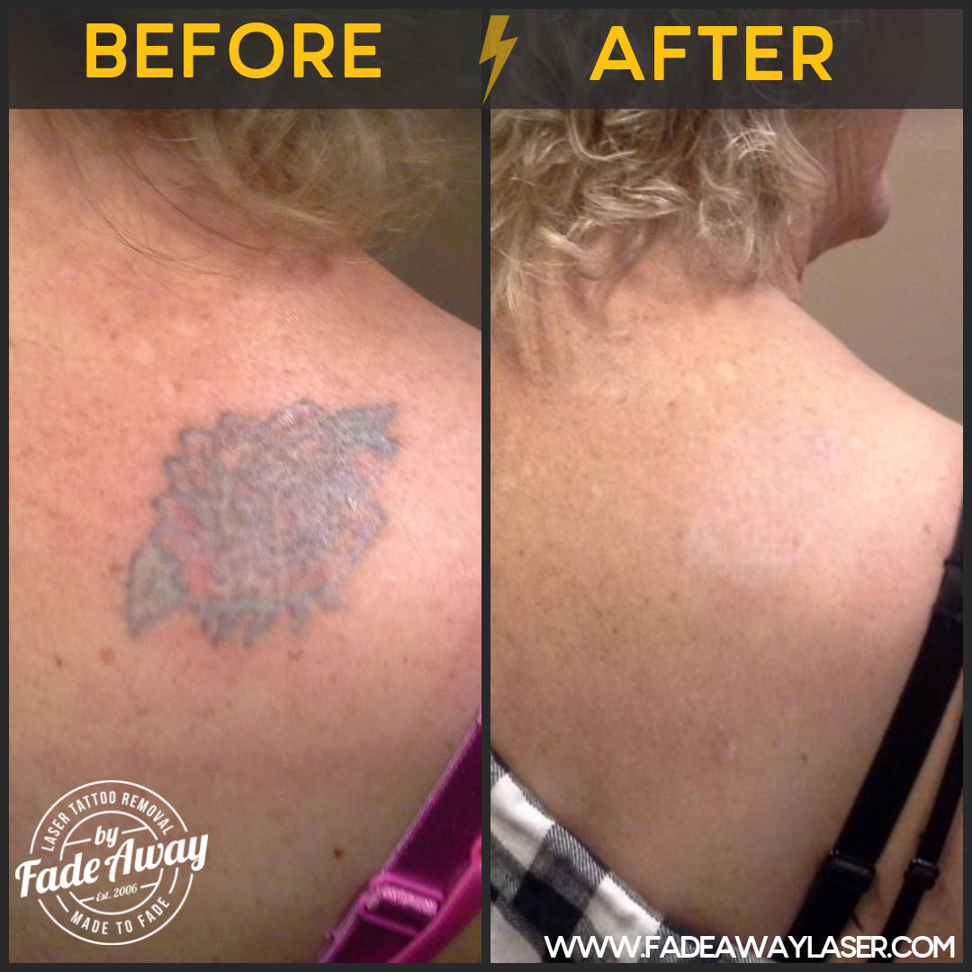 Portfolio Fade Away Laser