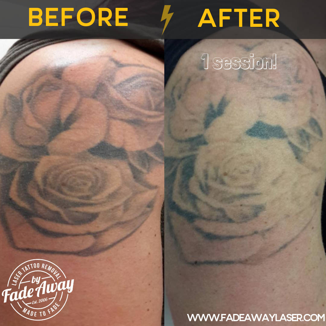 Portfolio Fade Away Laser