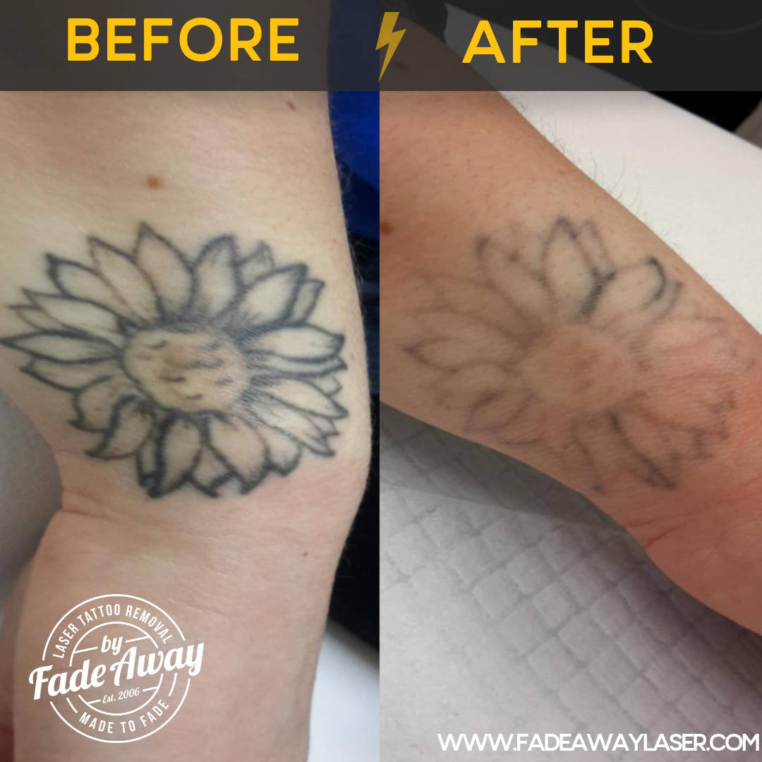 Portfolio Fade Away Laser