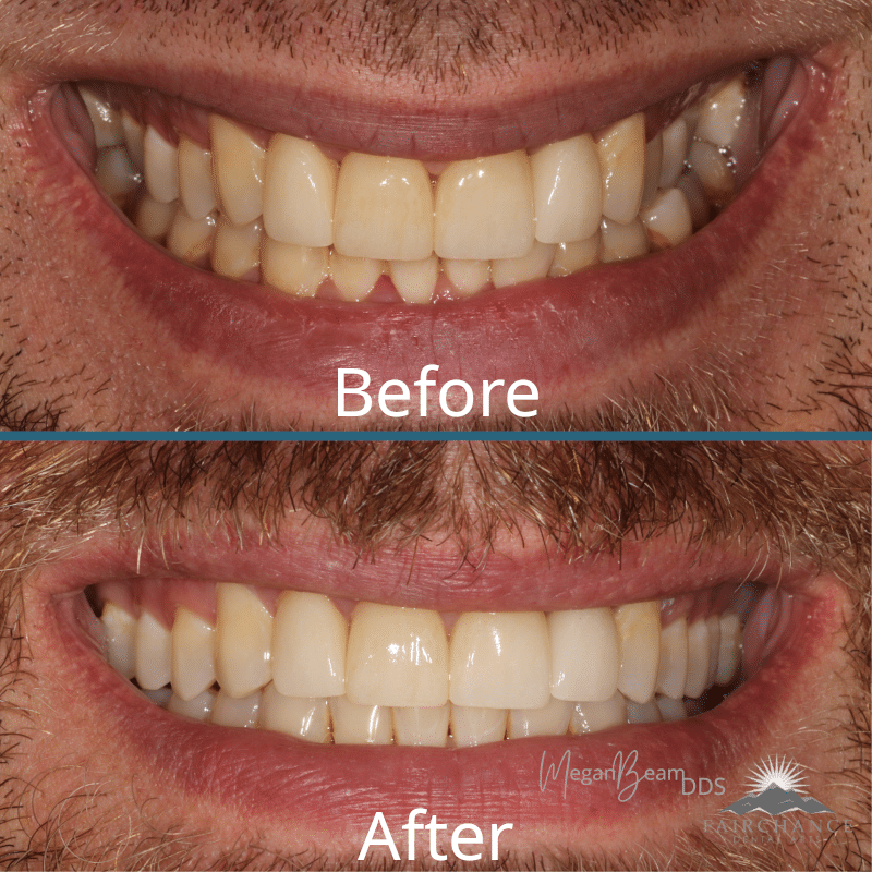 INVISALIGN® FOR A STRAIGHTER SMILE Fairchance Dental Arts